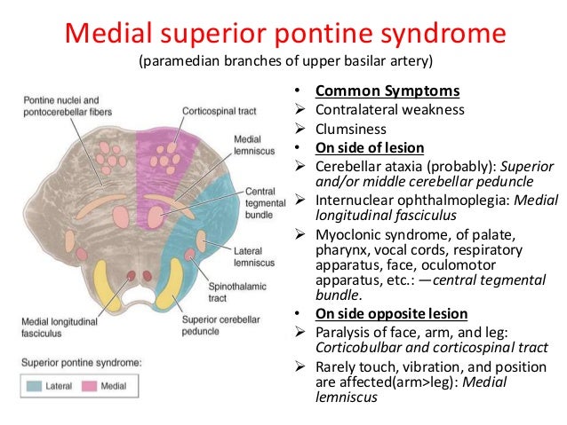 Medial Pontine Syndrome