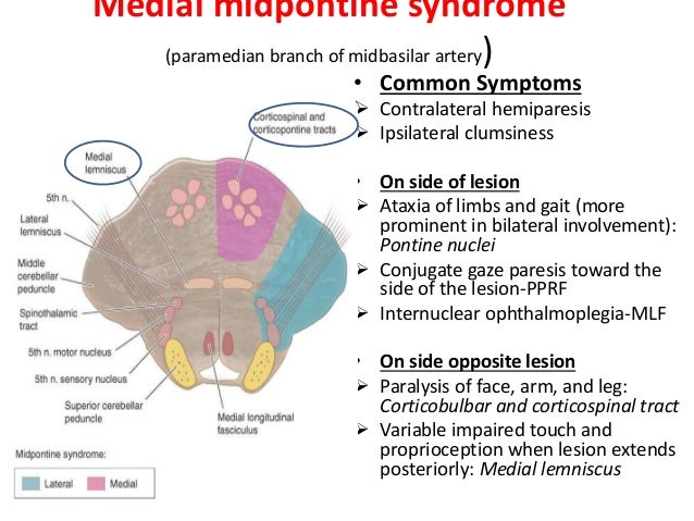 Medial Pontine Syndrome