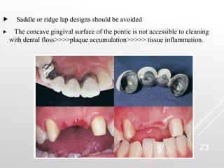 PONTICS IN FIXED PARTIAL DENTURE FOR ORAL | PPT