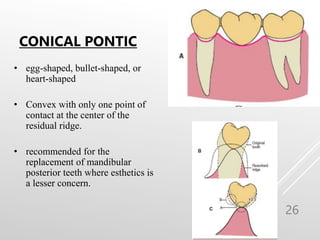 PONTICS IN FIXED PARTIAL DENTURE FOR ORAL | PPT