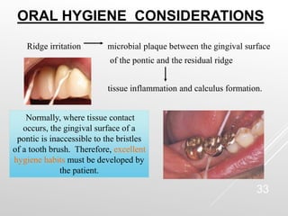 Calculus Ridge PONTICS IN FIXED PARTIAL DENTURE FOR ORAL | PPT