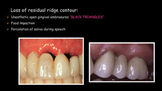 Loss of residual ridge contour:
 Unesthetic open gingival embrasures “BLACK TRIANGLES”
 Food impaction
 Percolation of saliva during speech
 