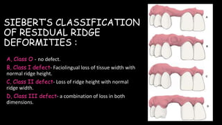 SIEBERT’S CLASSIFICATION
OF RESIDUAL RIDGE
DEFORMITIES :
A, Class O - no defect.
B, Class I defect- Faciolingual loss of tissue width with
normal ridge height.
C, Class II defect- Loss of ridge height with normal
ridge width.
D, Class III defect- a combination of loss in both
dimensions.
 
