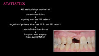 STATISTICS
91% residual ridge deformities

Anterior tooth loss

Majority are class III defects

Majority of patients with class II & class III defects

Unsatisfied with esthetics

Pre-prosthetic surgery
Ridge augmentation
 