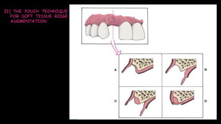 II] THE POUCH TECHNIQUE
FOR SOFT TISSUE RIDGE
AUGMENTATION:
 