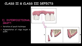 CLASS II & CLASS III DEFECTS
I] INTERPOSITIONAL
GRAFT:
 Variation of pouch technique
 Augmentation of ridge height &
width
 