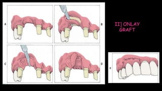 II] ONLAY
GRAFT
 