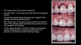 • The tissue side of the pontic should be:
• an ovate form - 2.5 mm apical to the facial free gingival
margin
• The pontic causes tissue blanching as it supports the
papillae and facial/palatal gingiva.
• The tissue side of the pontic must conform to within 1
mm of the interproximal and facial bone contour to act
as a template for healing.
• After approximately 1 month of healing, oral hygiene
access is improved by recontouring the pontic to
provide 1 to 1.5 mm of relief from the tissue.
 