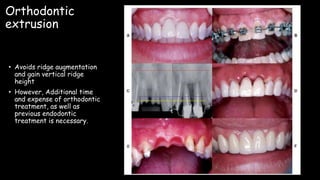 Orthodontic
extrusion
• Avoids ridge augmentation
and gain vertical ridge
height
• However, Additional time
and expense of orthodontic
treatment, as well as
previous endodontic
treatment is necessary.
 