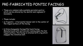 PRE-FABRICATED PONTIC FACINGS
• These are commercially available porcelain pontics
which can be altered by the dentist and reglazed if
necessary.
• These include:
• a) Trupontic – A horizontal tubular slot in the center of
the lingual surface of the facing.
• b) Interchangeable facings/flat back facing–
Manufactured with vertical slot running down the flat
lingual surface, this facing is retained with a lug which
engages the retention slot.
 