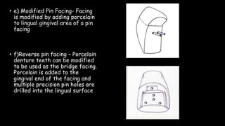 • e) Modified Pin Facing- Facing
is modified by adding porcelain
to lingual gingival area of a pin
facing
• f)Reverse pin facing – Porcelain
denture teeth can be modified
to be used as the bridge facing.
Porcelain is added to the
gingival end of the facing and
multiple precision pin holes are
drilled into the lingual surface
 