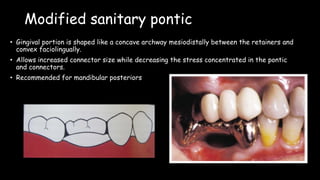 Modified sanitary pontic
• Gingival portion is shaped like a concave archway mesiodistally between the retainers and
convex faciolingually.
• Allows increased connector size while decreasing the stress concentrated in the pontic
and connectors.
• Recommended for mandibular posteriors
 