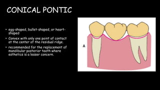 CONICAL PONTIC
• egg-shaped, bullet-shaped, or heart-
shaped
• Convex with only one point of contact
at the center of the residual ridge.
• recommended for the replacement of
mandibular posterior teeth where
esthetics is a lesser concern.
 