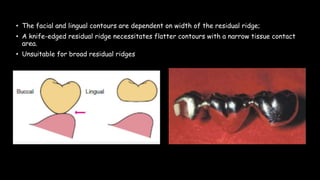 • The facial and lingual contours are dependent on width of the residual ridge;
• A knife-edged residual ridge necessitates flatter contours with a narrow tissue contact
area.
• Unsuitable for broad residual ridges
 