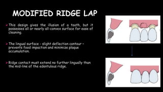 MODIFIED RIDGE LAP
This design gives the illusion of a tooth, but it
possesses all or nearly all-convex surface for ease of
cleaning.
The lingual surface - slight deflection contour –
prevents food impaction and minimize plaque
accumulation.
Ridge contact must extend no further lingually than
the mid-line of the edentulous ridge.
 