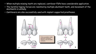 • When multiple missing teeth are replaced, cantilever FDPs have considerable application.
• The harmful tipping forces are resisted by multiple abutment teeth, and movement of the
abutments is unlikely.
• Cantilevers are also successfully used with implant-supported prostheses.
 