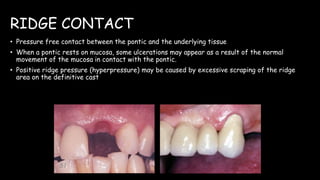 RIDGE CONTACT
• Pressure free contact between the pontic and the underlying tissue
• When a pontic rests on mucosa, some ulcerations may appear as a result of the normal
movement of the mucosa in contact with the pontic.
• Positive ridge pressure (hyperpressure) may be caused by excessive scraping of the ridge
area on the definitive cast
 