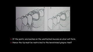  If the pontic encroaches on the unattached mucosa an ulcer will form.
 Hence the tip must be restricted to the keratinised gingiva itself
 