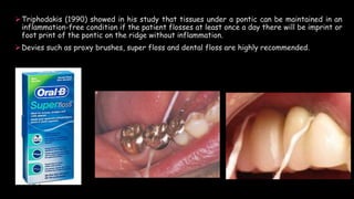 Triphodakis (1990) showed in his study that tissues under a pontic can be maintained in an
inflammation-free condition if the patient flosses at least once a day there will be imprint or
foot print of the pontic on the ridge without inflammation.
Devies such as proxy brushes, super floss and dental floss are highly recommended.
 