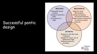 Successful pontic
design
 