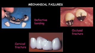 Defective
bonding
Cervical
fracture
Occlusal
fracture
MECHANICAL FAILURES
 