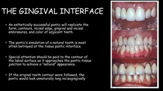 THE GINGIVAL INTERFACE
• An esthetically successful pontic will replicate the
form, contours, incisal edge, gingival and incisal
embrasures, and color of adjacent teeth.
• The pontic’s simulation of a natural tooth is most
often betrayed at the tissue pontic interface.
• Special attention should be paid to the contour of
the labial surface as it approaches the pontic-tissue
junction to achieve a “natural” appearance.
• If the original tooth contour were followed, the
pontic would look unnaturally long incisogingivally
 