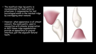 • The modified ridge-lap pontic is
recommended for most anterior
situations; it compensates for lost
buccolingual width in the residual ridge
by overlapping what remains
• However, when appearance is of utmost
concern, the ovate pontic, used in
conjunction with alveolar preservation
or soft tissue ridge augmentation-
provide an appearance at gingival
interface just like adjacent natural
teeth.
 
