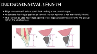 INCISOGINGIVAL LENGTH
• Ridge resorption will make a pontic look too long in the cervical region.
• An abnormal labiolingual position or cervical contour, however, is not immediately obvious.
• This fact can be used to produce a pontic of good appearance by recontouring the gingival
half of the labial surface
 