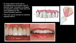 • In areas where tooth loss is
accompanied by excessive loss of
alveolar bone, the pontic is shaped
to simulate a normal crown and root
with emphasis on the
cementoenamel junction.
• The root can be stained to simulate
exposed dentin
 