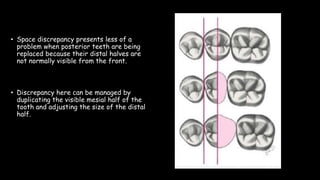 • Space discrepancy presents less of a
problem when posterior teeth are being
replaced because their distal halves are
not normally visible from the front.
• Discrepancy here can be managed by
duplicating the visible mesial half of the
tooth and adjusting the size of the distal
half.
 