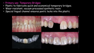• Primary use: Temporary Bridges
• Plastic to fabricate quick and economical temporary bridges.
• Wear-resistant, vacuum processed synthetic resin
• Special lingual channel ensures pontic locks into the plastic
 