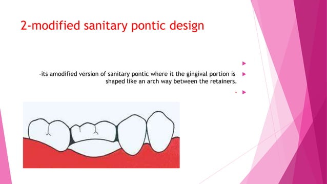Pontic design and finish line.pptx