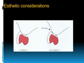 Esthetic considerations
 