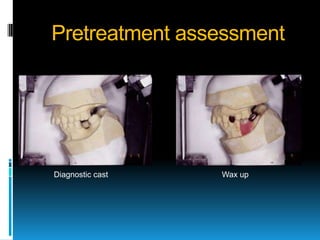 Pretreatment assessment




Diagnostic cast   Wax up
 