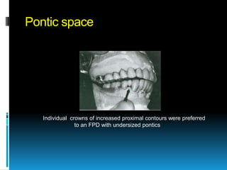 Pontic space




   Individual crowns of increased proximal contours were preferred
                to an FPD with undersized pontics
 