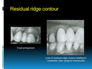 Residual ridge contour




   Food entrapment



                     Loss of residual ridge contour leading to
                      unesthetic open gingival embrasures
 