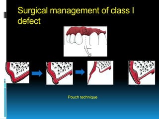 Surgical management of class I
defect




            Pouch technique
 