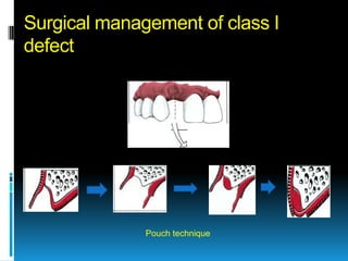Surgical management of class I
defect




              Pouch technique
 