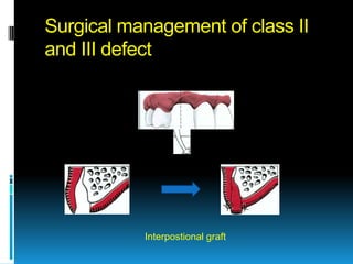 Surgical management of class II
and III defect




           Interpostional graft
 