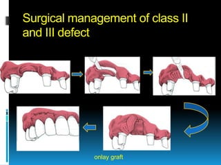 Surgical management of class II
and III defect




             onlay graft
 