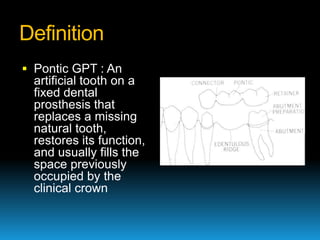 Definition
 Pontic GPT : An
  artificial tooth on a
  fixed dental
  prosthesis that
  replaces a missing
  natural tooth,
  restores its function,
  and usually fills the
  space previously
  occupied by the
  clinical crown
 
