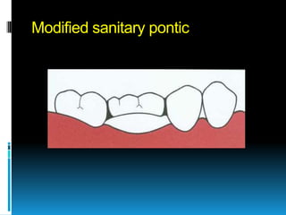 Modified sanitary pontic
 