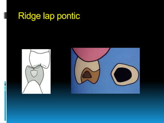 Ridge lap pontic
 