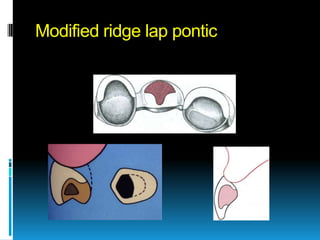 Modified ridge lap pontic
 