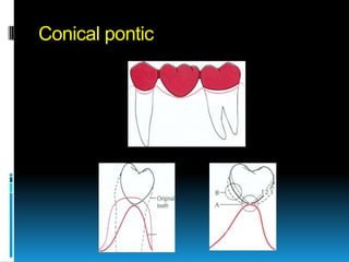 Conical pontic
 