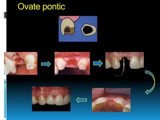 Ovate pontic
 