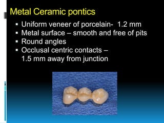 Metal Ceramic pontics
    Uniform veneer of porcelain- 1.2 mm
    Metal surface – smooth and free of pits
    Round angles
    Occlusal centric contacts –
     1.5 mm away from junction
 
