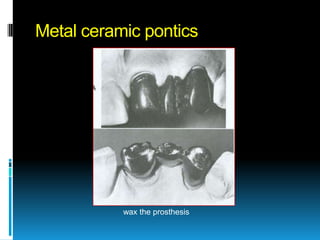 Metal ceramic pontics




           wax the prosthesis
 