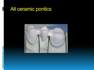 All ceramic pontics
 