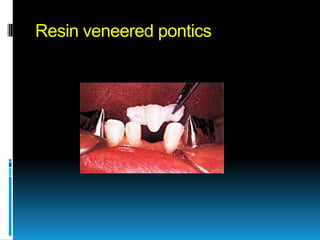 Resin veneered pontics
 